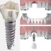 implantes_dentales