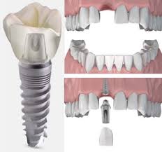 implantes_dentales